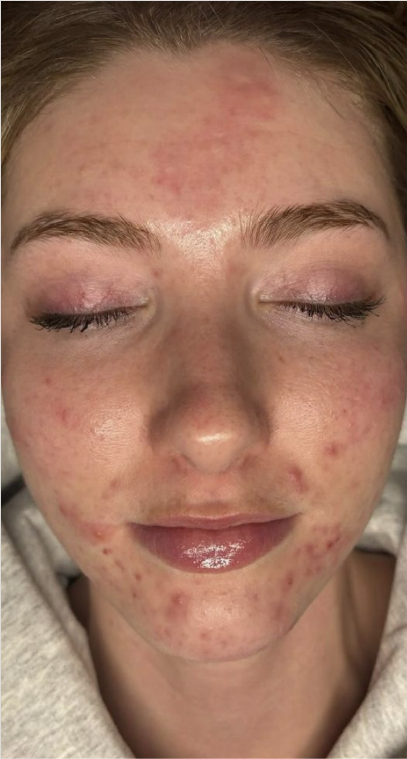 Reyna Esthetics Before 1