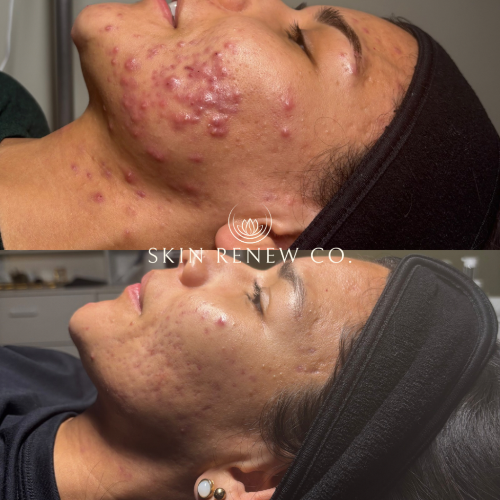 Before and after acne treatment at Skin Renew Co. in Grandville, MI, showing reduced inflammation and smoother skin after consistent facials.