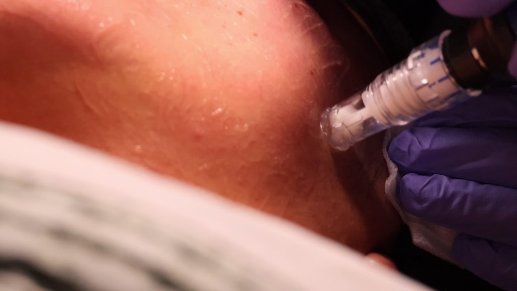 Close-up of SkinPen microneedling treatment being performed on facial skin.